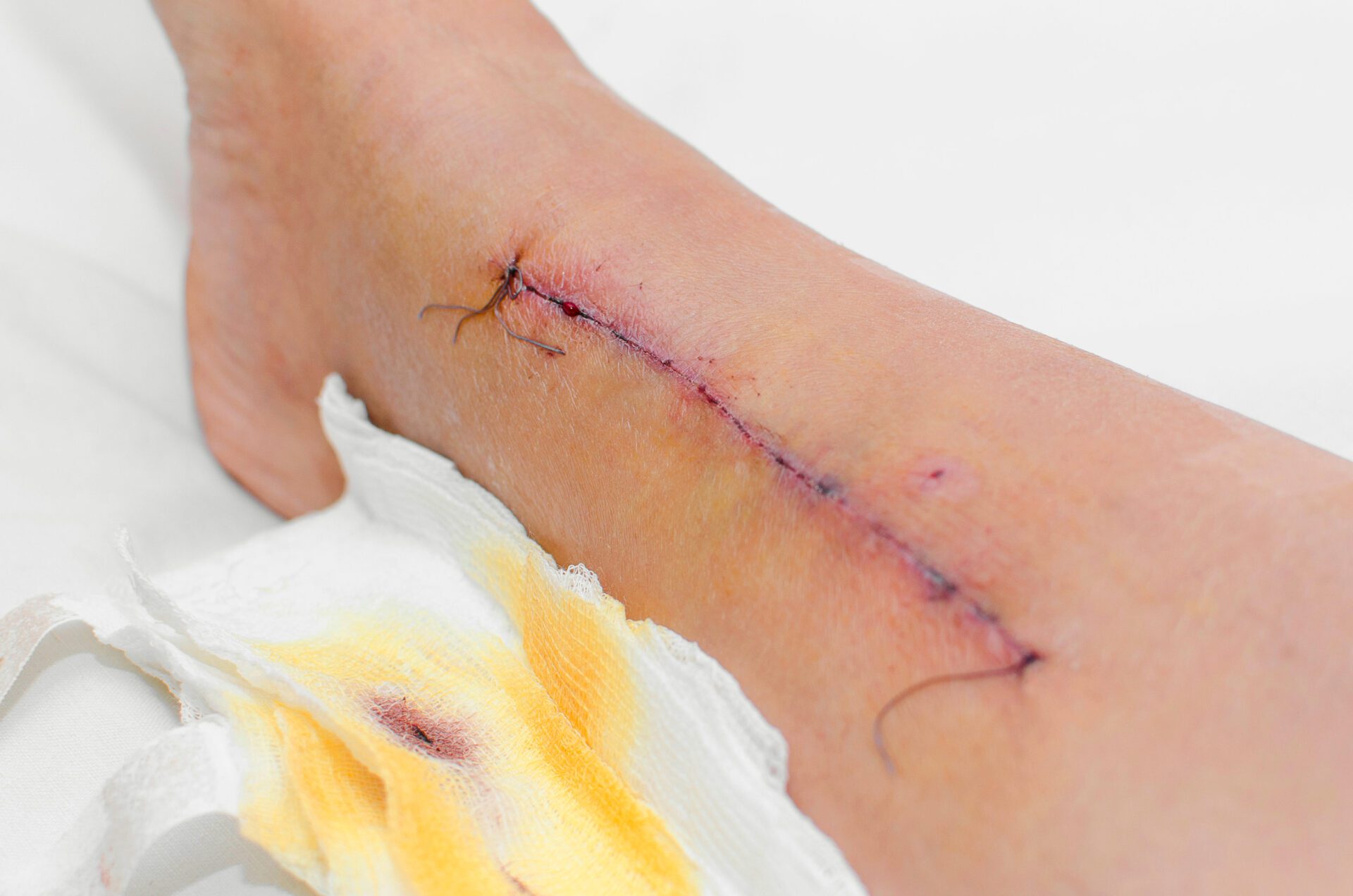 Medical suture on the legMedical suture on the legMedical suture on the leg Medical suture on the leg