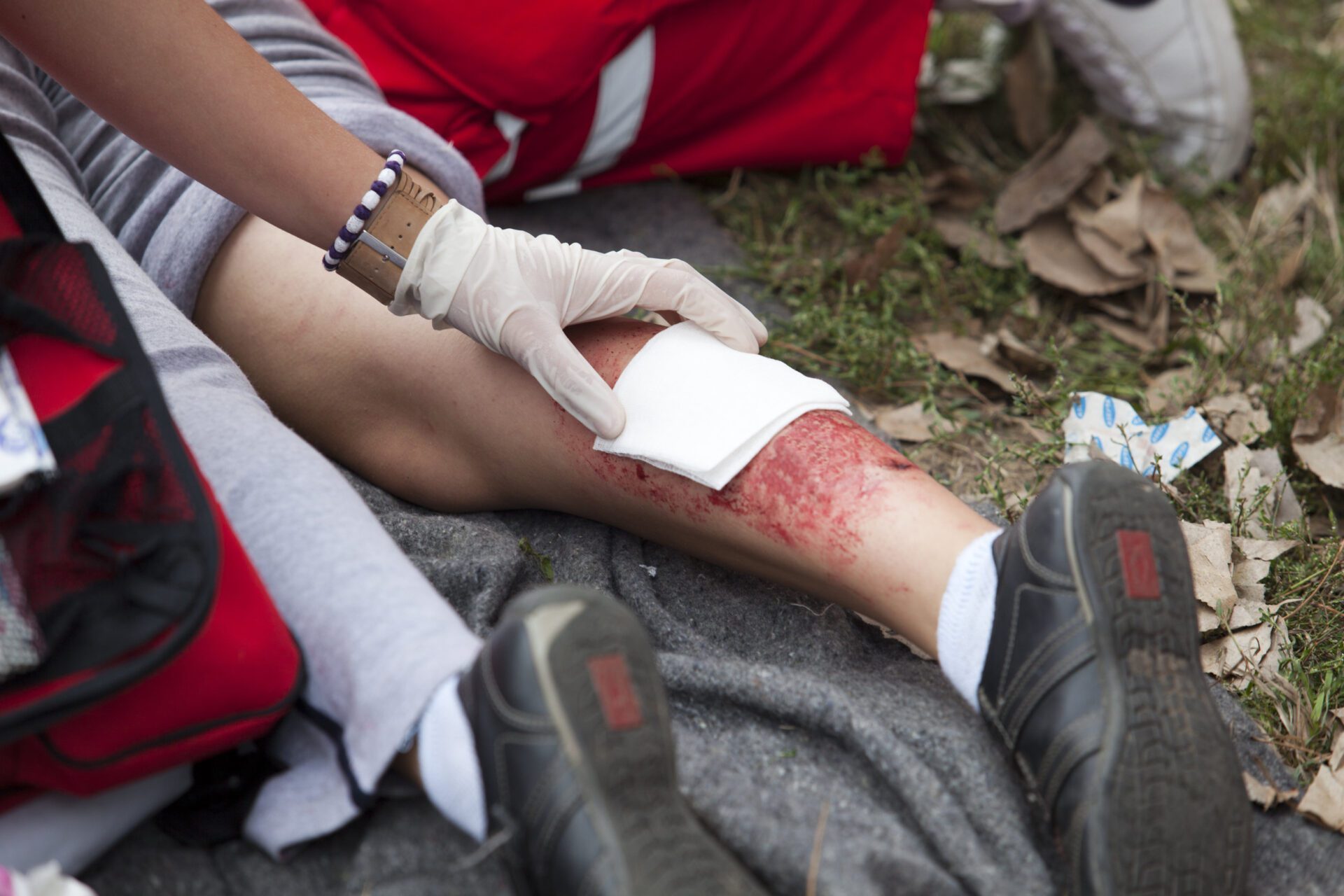 Burn being treated Burn being treated
